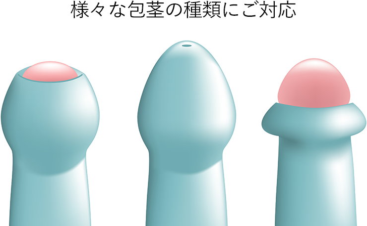様々な包茎の種類にご対応します